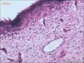宫颈赘生物，是报血管瘤还是报血管样息肉图6