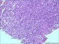淋巴细胞浸润与否图9