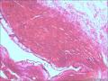 宫颈赘生物，是报血管瘤还是报血管样息肉图11