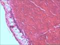 宫颈赘生物，是报血管瘤还是报血管样息肉图1