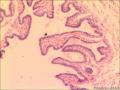输卵管系膜囊肿图2