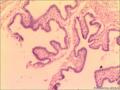 输卵管系膜囊肿图1