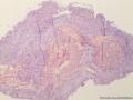 膀胱新生物图3