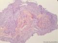 膀胱新生物图1