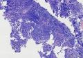 慢性炎，间质里的小灶上皮细胞可疑。图7
