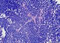 慢性炎，间质里的小灶上皮细胞可疑。图9