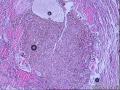 58岁，甲状腺囊实性肿物。图3