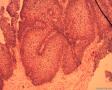 内翻性乳头状瘤OR鳞状细胞乳头状瘤？图8