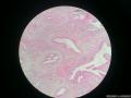 胆囊表面赘生物图6