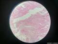 胆囊表面赘生物图7
