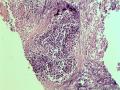 肺小细胞癌图3