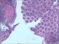 肠镜标本，看淋巴细胞是否有问题图16