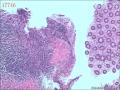 肠镜标本，看淋巴细胞是否有问题图13