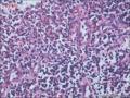 肠镜标本，看淋巴细胞是否有问题图7