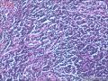 肠镜标本，看淋巴细胞是否有问题图19