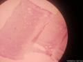 左侧睾丸鞘膜积液图11