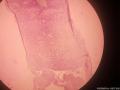 左侧睾丸鞘膜积液图14