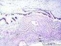 卵巢囊肿图18