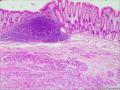 左半结肠粘膜下肿物图1