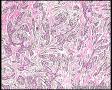 乳腺癌免疫组化请教图9