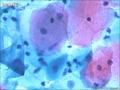 HPV阳性，细胞还行吗？图7