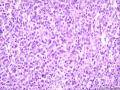(胃窦溃疡ESD标本)：淋巴瘤？图15