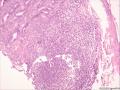 (胃窦溃疡ESD标本)：淋巴瘤？图4