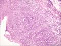 (胃窦溃疡ESD标本)：淋巴瘤？图2