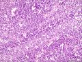 (胃窦溃疡ESD标本)：淋巴瘤？图8