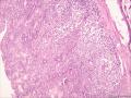 (胃窦溃疡ESD标本)：淋巴瘤？图3