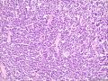 (胃窦溃疡ESD标本)：淋巴瘤？图14