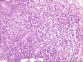 (胃窦溃疡ESD标本)：淋巴瘤？图5