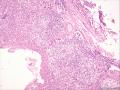 (胃窦溃疡ESD标本)：淋巴瘤？图1