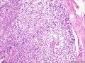 (胃窦溃疡ESD标本)：淋巴瘤？图6