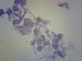 肾囊肿脱落细胞 这是什么细胞？图8