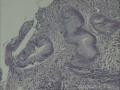 距门齿40CM食管黏膜图17