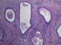 附睾组织，是精子肉芽肿吗？图4