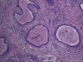 附睾组织，是精子肉芽肿吗？图3