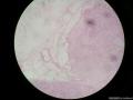 腮腺混合瘤图4