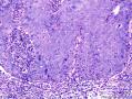 表皮肿物 脂溢性角化病伴HPV感染？不典型增生？图33