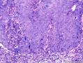 表皮肿物 脂溢性角化病伴HPV感染？不典型增生？图6