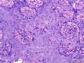 表皮肿物 脂溢性角化病伴HPV感染？不典型增生？图2
