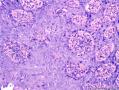 表皮肿物 脂溢性角化病伴HPV感染？不典型增生？图5