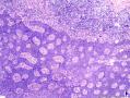 表皮肿物 脂溢性角化病伴HPV感染？不典型增生？图18