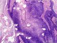 表皮肿物 脂溢性角化病伴HPV感染？不典型增生？图14