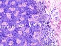 表皮肿物 脂溢性角化病伴HPV感染？不典型增生？图1