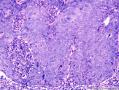 表皮肿物 脂溢性角化病伴HPV感染？不典型增生？图27