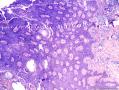 表皮肿物 脂溢性角化病伴HPV感染？不典型增生？图19