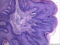肛周包块，是发鳞状上皮乳头状瘤还是纤维上皮性息肉图7