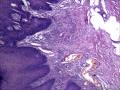 肛周包块，是发鳞状上皮乳头状瘤还是纤维上皮性息肉图8